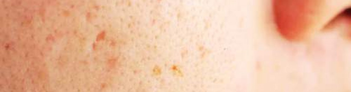 Hoe ik van mijn acne afkwam – het natuurlijke geheim dat mijn huid redde
