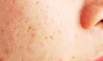 Hoe ik van mijn acne afkwam – het natuurlijke geheim dat mijn huid redde